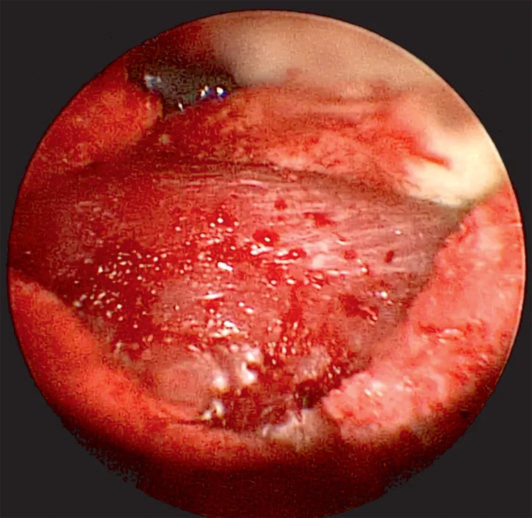 Endoscopic view on the Lumbar Posterior Lateral