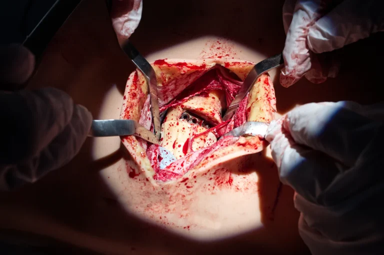 Implant placement training on the Lumbar Anterior Lateral